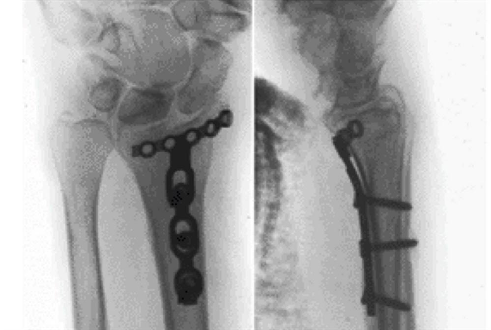 Garden Spade Deformity Adalah Fasci Garden